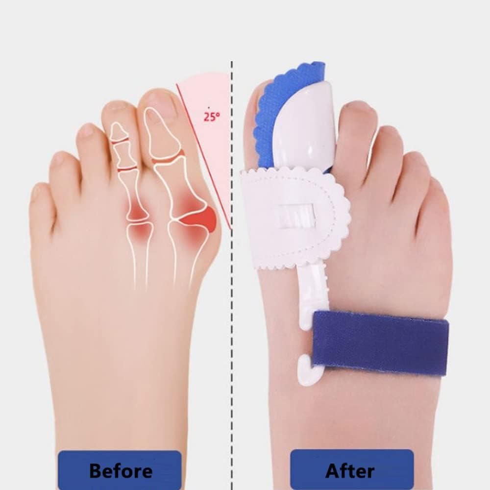 Bunion Splint Corrector – Orthopedic Toe Separator & Foot Brace for Hallux Valgus Relief (Pair) Vallinex Ventures