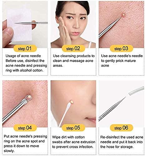 Blackhead Remover Tool Set – Stainless Steel Acne Extractor Kit for Pimple Removal (4 Pcs) Vallinex Ventures
